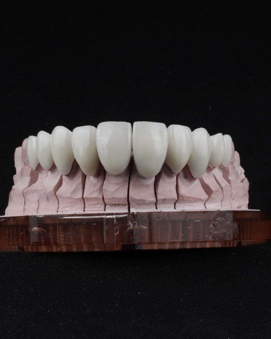 Dentadura fabricada en nuestro laboratorio dental