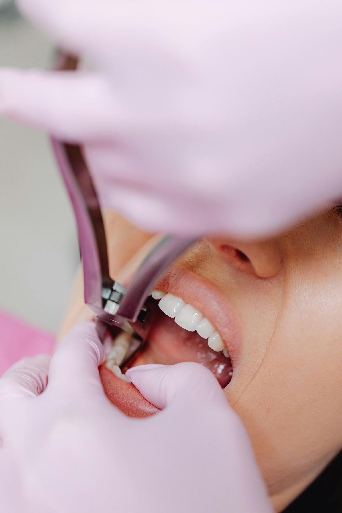Limpieza dental profesional