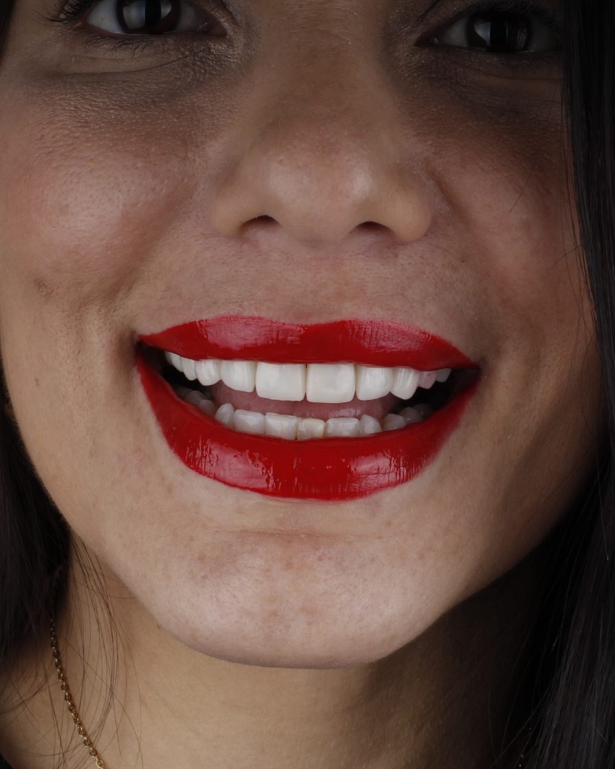 Sonrisa blanca de una paciente después de su tratamiento
