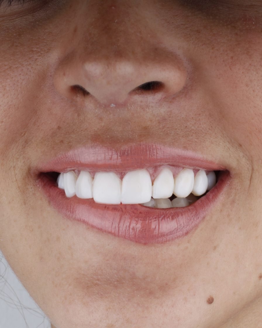 Sonrisa de una paciente de nuestra clínica de Gaithersburg