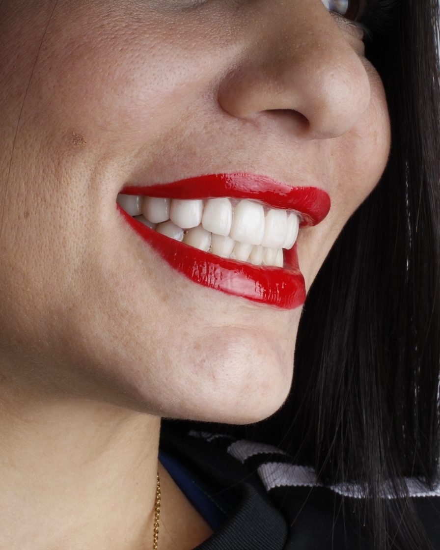Sonrisa de una paciente de nuestra clínica de Oakton