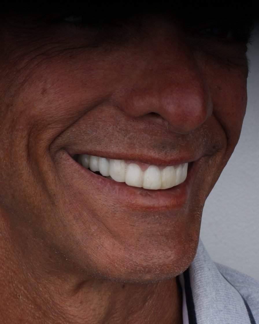 Paciente sonriendo con su nueva prótesis dental