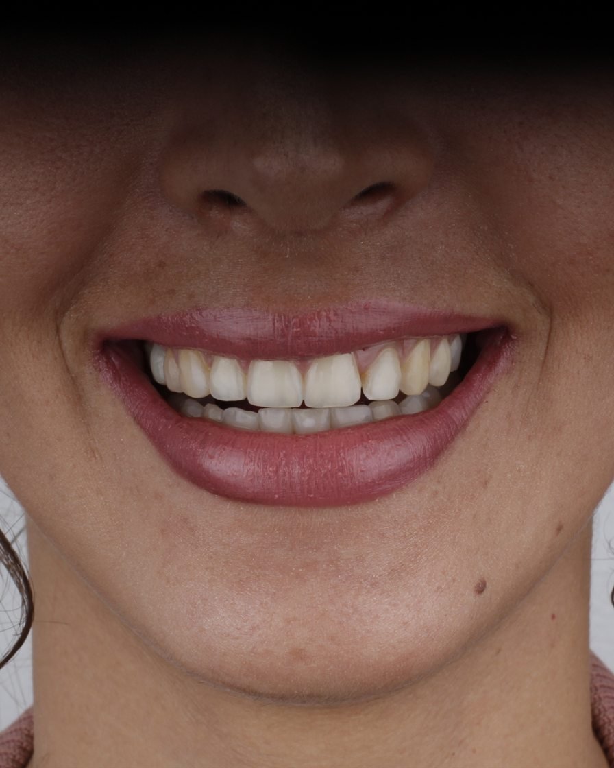 Sonrisa de una paciente de nuestra clínica de Silver Spring
